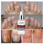 LANBENA Nail Repair Essence – Before & After Results Showing Treatment for Fungal, Discoloured & Damaged Toenails