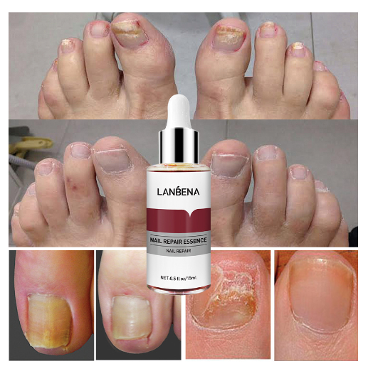 LANBENA Nail Repair Essence – Before & After Results Showing Treatment for Fungal, Discoloured & Damaged Toenails