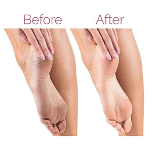 Before and after comparison of feet with calluses on a white background