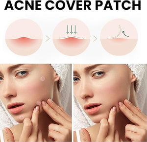 Acne Cover Patch (72pc) - Ultra-Thin Invisible Hydrocolloid Pimple Patches