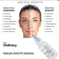 Advertisement for 'The Ordinary' Salicylic Acid 2% Solution with a split image of a woman's face before and after a skin peel.